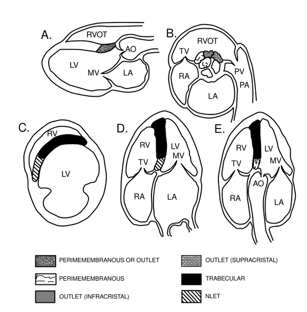 Ventricular Septal Defect (VSD) - Echopedia