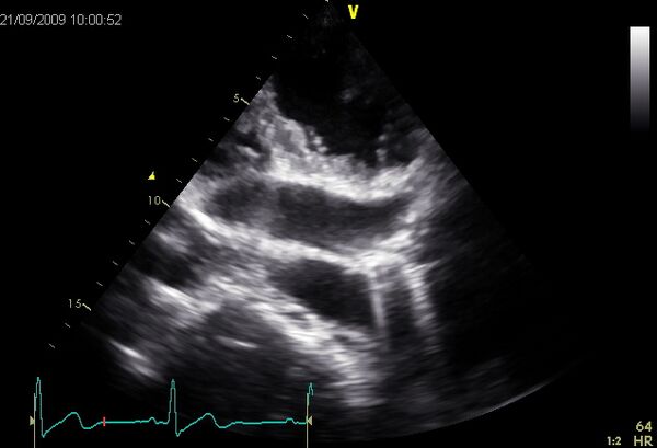 Vena Cava Superior Sinistra Persistent (VCSSP) - Echopedia